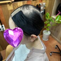 画像1568：円形脱毛をシルエクステでカバー例です