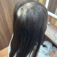 画像2134：円形脱毛をシルエクステでカバー例です